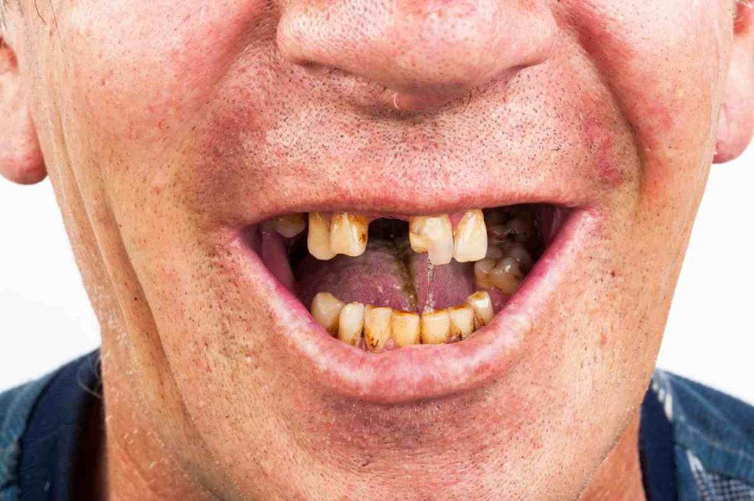 strata zubov nezdrava ustna dutina