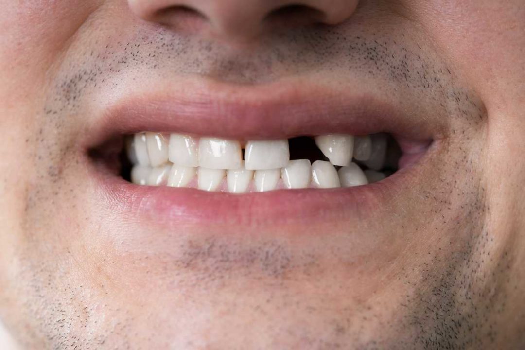 zuby cloveka