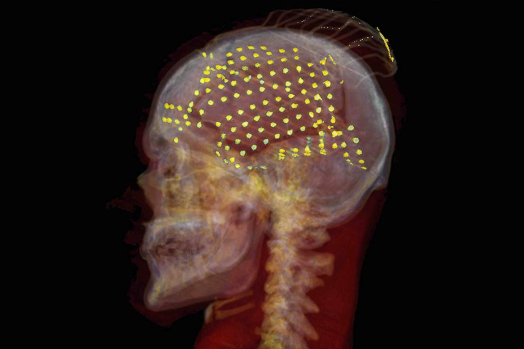 Vedci môžu na základe dešifrovania mozgových signálov vrátiť hlas nemým pacientom