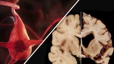 Vedci odhalili zmeny v mozgu, prebiehajúce počas alzheimerovej choroby