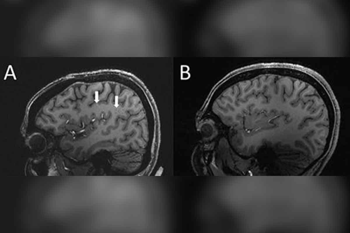 Čo sa deje v našom mozgu počas migrény? 