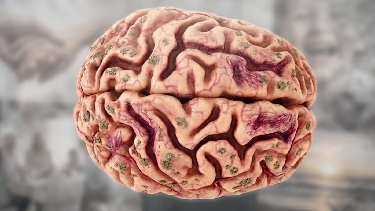 Vedci upravili vitamín K a v mozgu spustili zvláštny proces. Môže ukázať cestu k liečbe Alzheimera