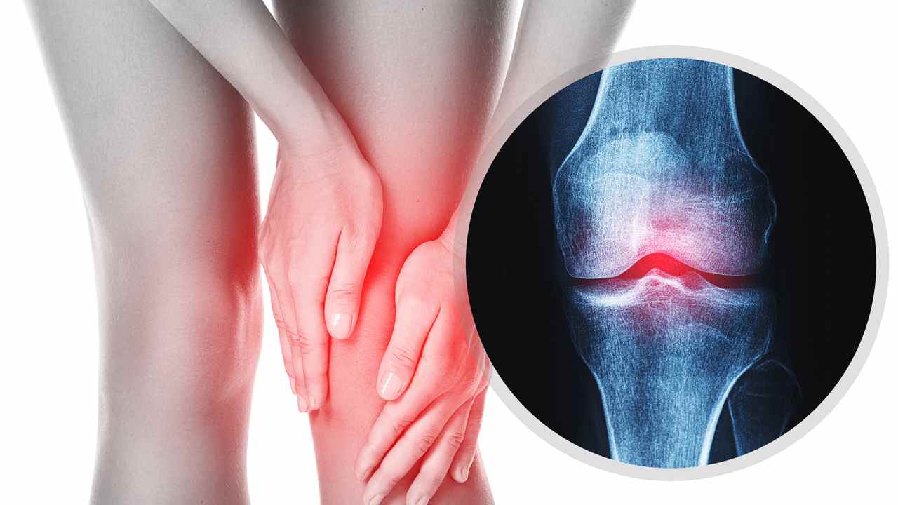 Bolí ťa koleno? Táto častá reakcia môže osteoartrózu ešte zhoršiť